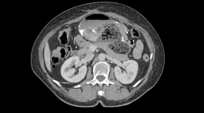 Woman’s stomach condition cured after doctors tell her to drink liters of Diet Coke